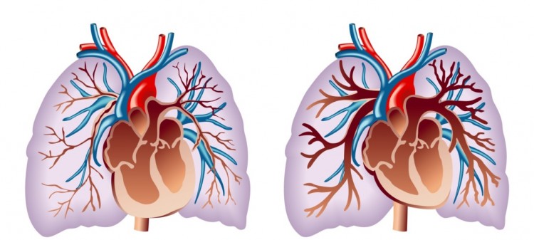 Pulmão doente (esq) e pulmão saudável (dir). Na hipertensão pulmonar a obstrução das artérias (em vermelho) faz o lado direito do coração (lado esquerdo na figura) ficar hipertrofiado.